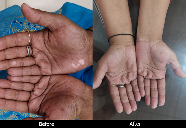 hair Fall treatment in lucknow