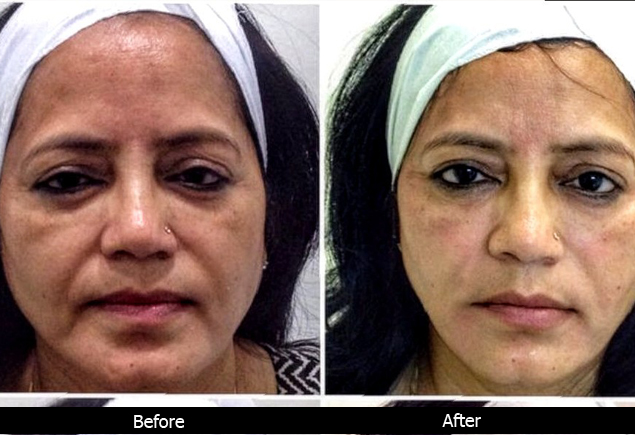 Laser treatment in lucknow