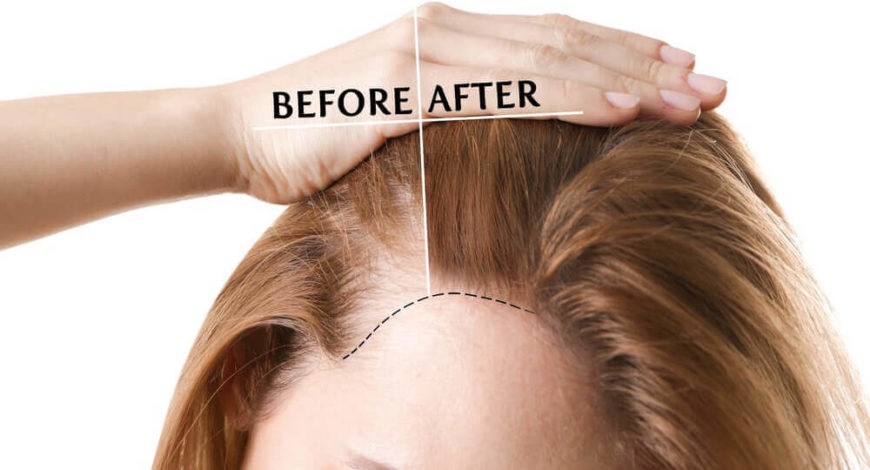 Hair Fall Treatment in  Lucknow