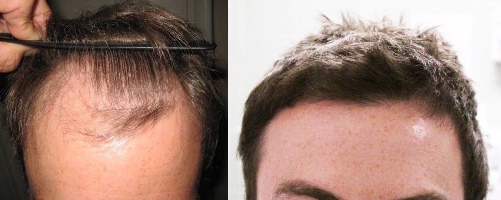 hair transplant in Lucknow